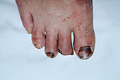Amputated toe