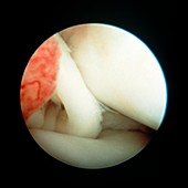 Torn knee meniscus
