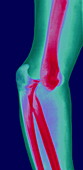 Dislocated elbow joint,X-ray