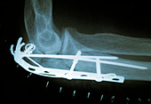 Pinned elbow fracture,X-ray