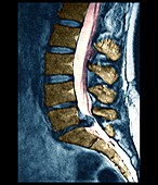 Slipped disc,MRI