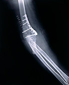 Pinned elbow fracture,X-ray