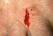 Lacerated hand