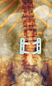 Pinned vertebrae,X-ray