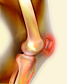 Pinned kneecap fracture,X-ray