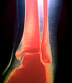 Broken lower leg bone,X-ray