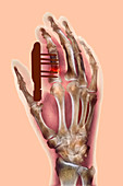 Pinned finger fracture,X-ray