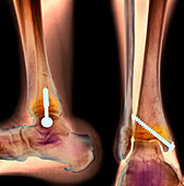 Pinned ankle fracture,two views,X-ray