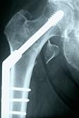 Broken hip,X-ray