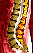 Spine degeneration,MRI scan