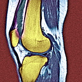 Knee effusion