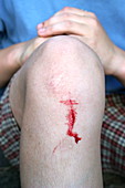 Cut knee