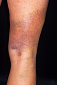 Bruised thigh