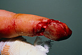 Finger wound