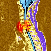 Broken neck,MRI