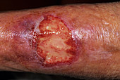 Infected wound