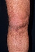 Torn knee ligament