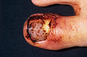 Injured toe