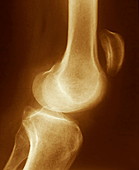 Dislocated kneecap,X-ray