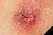 Wound infection