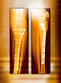 Pinned broken leg,X-rays