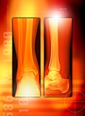 Healing ankle fracture,X-ray