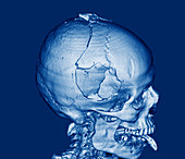 Fractured skull,CT scan