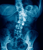 Broken back,X-ray