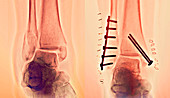 Pinned ankle fractures,X-ray