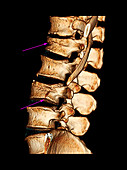 Fractured spine,3D CT scan