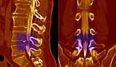 Slipped disc,CT scans