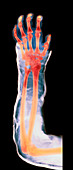 Broken arm in plaster cast,X-ray