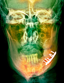 Pinned broken jaw,X-ray
