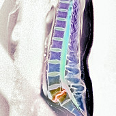 Slippage of a vertebra,MRI scan
