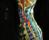 Fractured spine,MRI scan