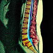 Slippage of a vertebra,MRI scan