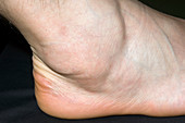 Swollen ankle