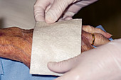 Dressing a hand wound