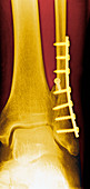Pinned ankle fracture,coloured X-ray