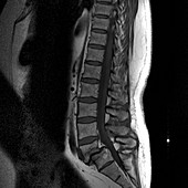 Slipped vertebra,MRI scan