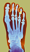 Dislocated toe,X-ray
