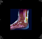 Torn Achilles tendon,MRI scan
