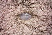 Umbilical hernia