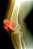 Kneecap fracture,X-ray