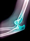 Dislocated elbow,X-ray