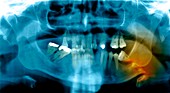 Fractured jawbone,X-ray