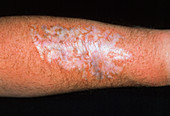 Scar on forearm after tattoo removal