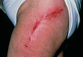 Close up of an infected post-operative leg scar
