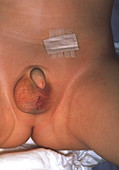 Surgical scrotal scar