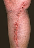 Heart surgery leg scar